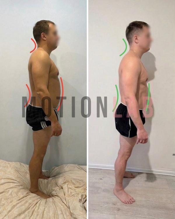 Осанка и грудной кифоз