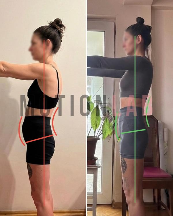 Передний наклон таза