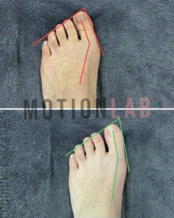 Вальгус большого пальца