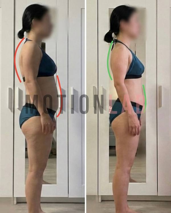 Сутулость и гиперлордоз