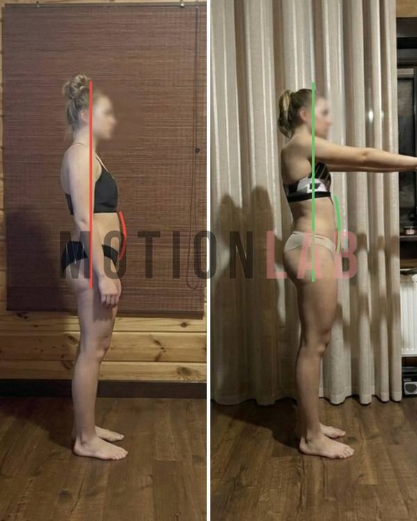 Передний наклон таза