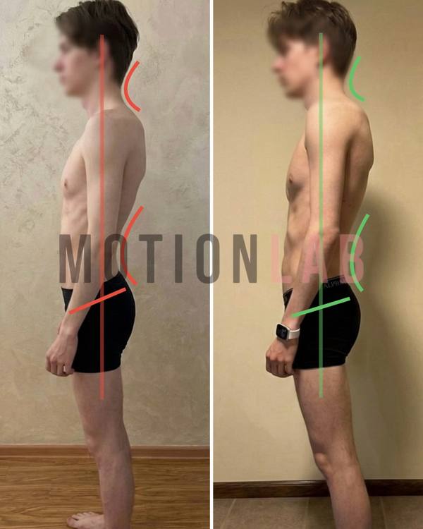 Осанка у подростка