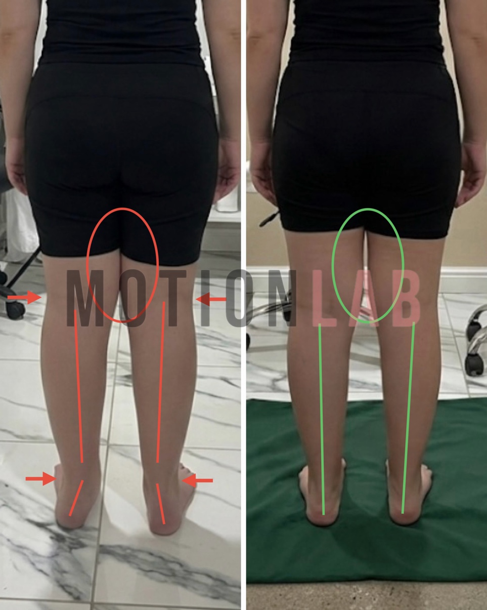 Вальгусные колени