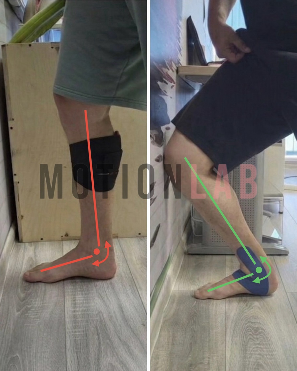 Нестабильность голеностопа