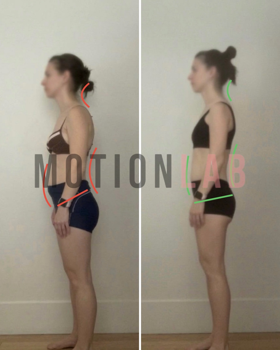 Коррекция осанки и наклона таза